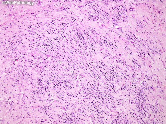 Adrenal_Neuroblastoma32_Diff.jpg