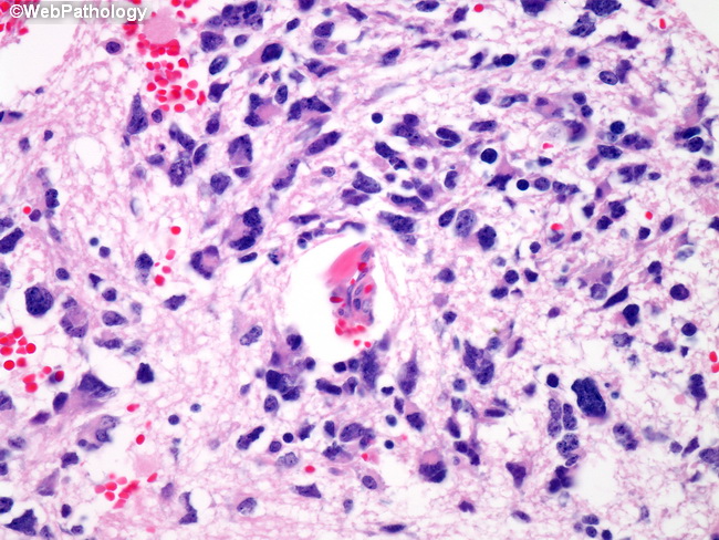 Adrenal_Neuroblastoma33.jpg