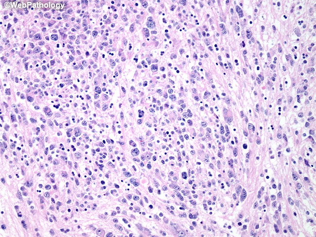 Adrenal_Neuroblastoma35.jpg