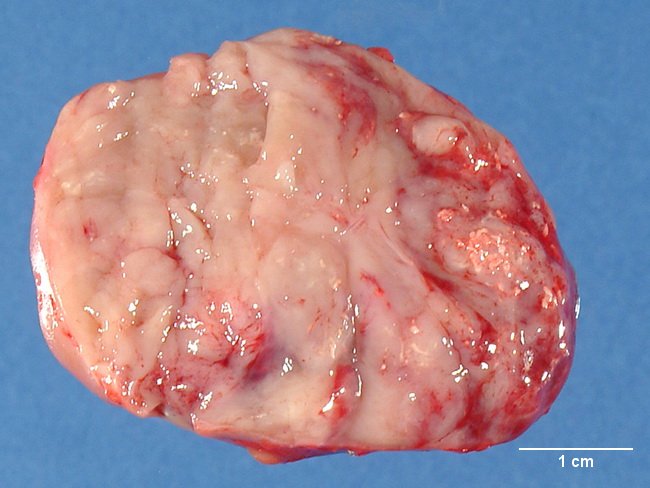 Adrenal_Neuroblastoma_Gross7.jpg