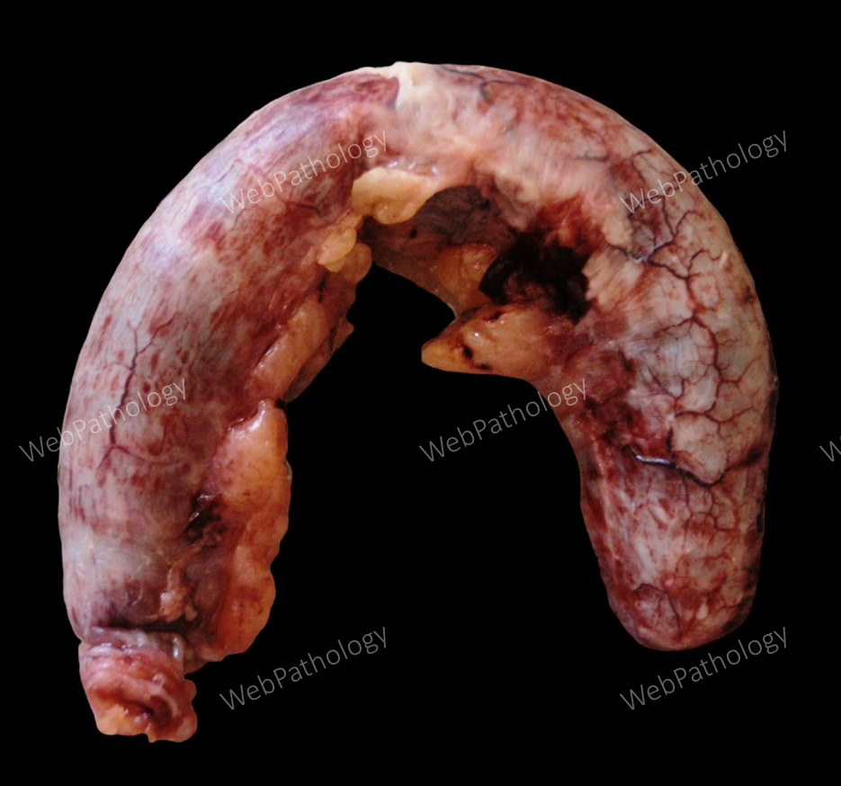 Appendix_Appendicitis_Obstructive_58yo_IZ.jpg