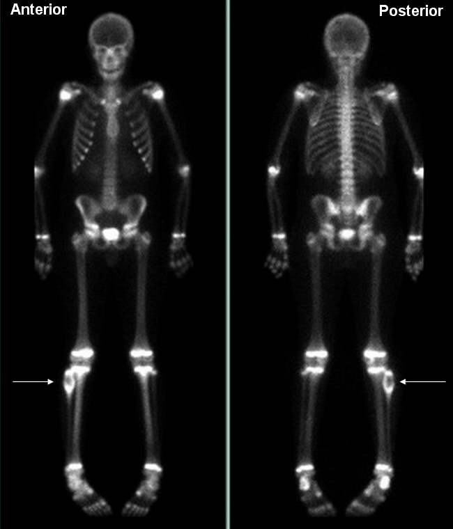 Bone_AneurysmalBoneCyst_Imaging1B_Composite(1).jpg