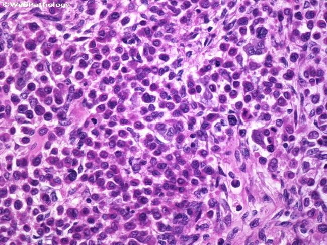 Bone_Chondroblastoma4.jpg