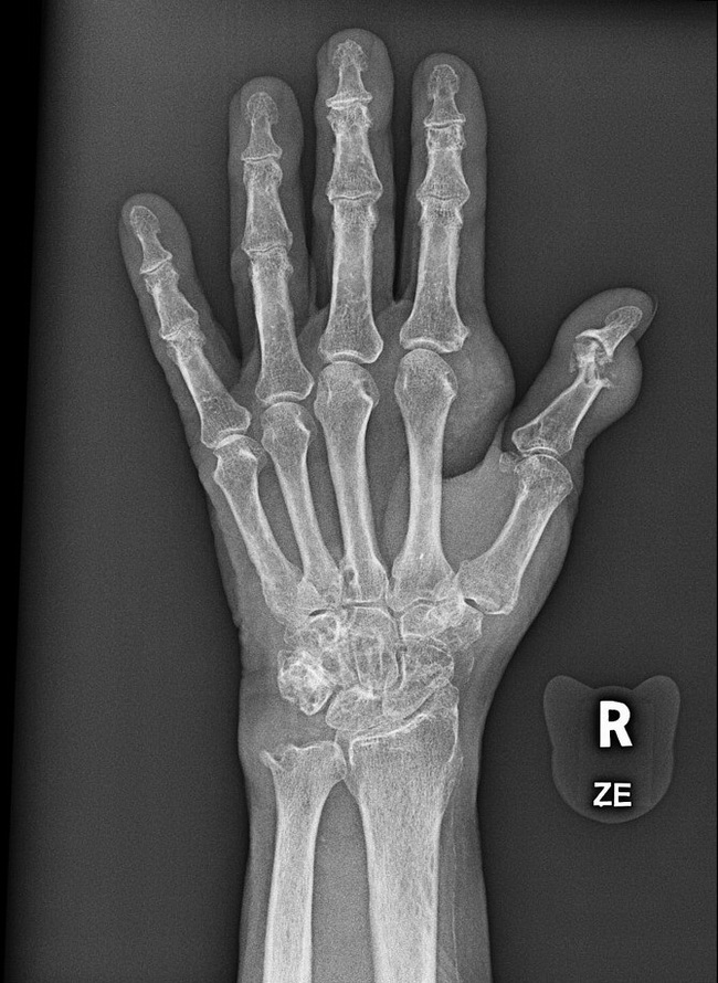 Bone_Gout_Radiology5_resized.jpg