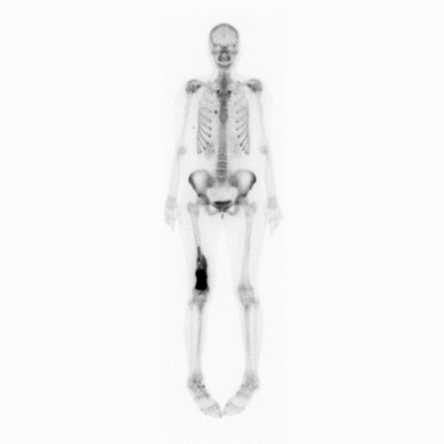 Bone_Osteosarcoma_Radiology_1C.jpg