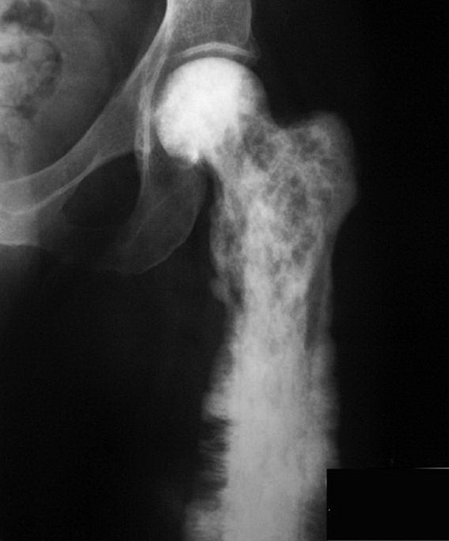 Bone_PagetDz_Radiology3_resized.jpg