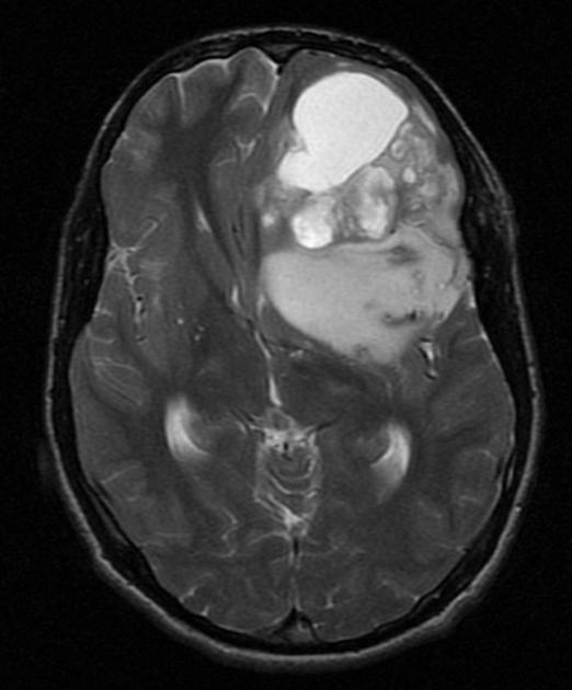 Brain_Astrocytoma_Gemistocytic_RadiographicImages1(1).jpg