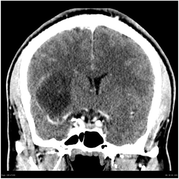 Brain_Astrocytoma_LowGrade_Radiology(1).jpg