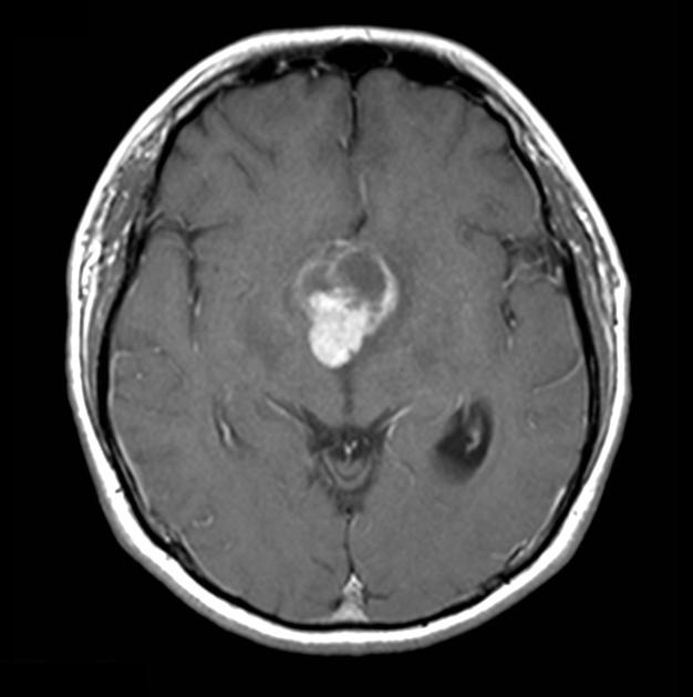 Brain_Craniopharyngioma_Radiology2.jpg