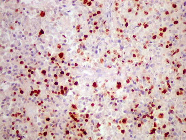 Ependymoma In Adults 116
