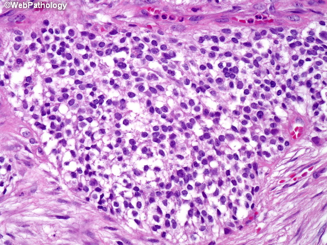 Brain_Ependymoma_ClearCell2.jpg