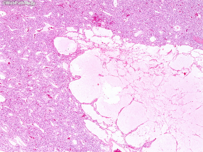 Brain_Hemangioblastoma10.jpg