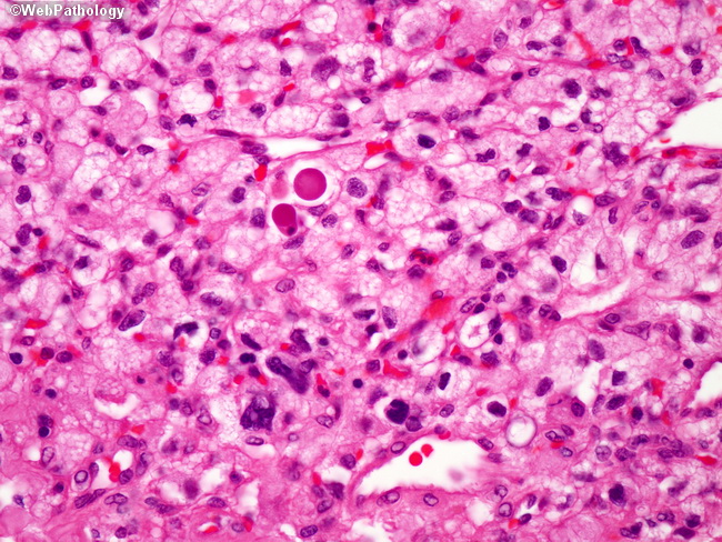 Brain_Hemangioblastoma22.jpg