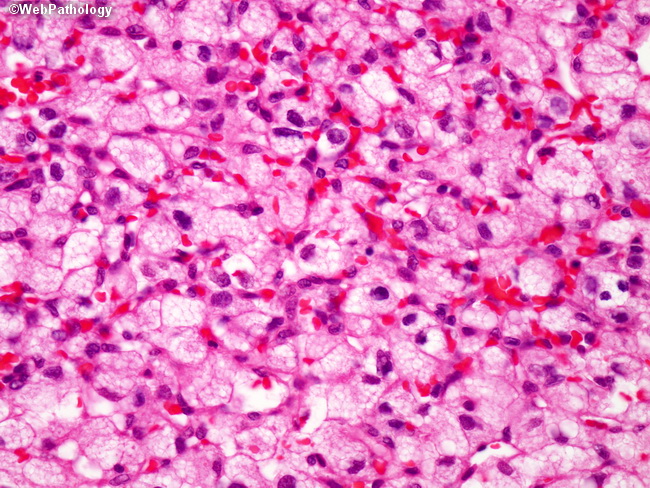 Brain_Hemangioblastoma23.jpg