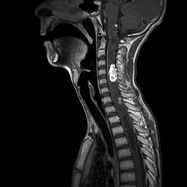 Brain_Hemangioblastoma_Radiology1_VHL.jpg