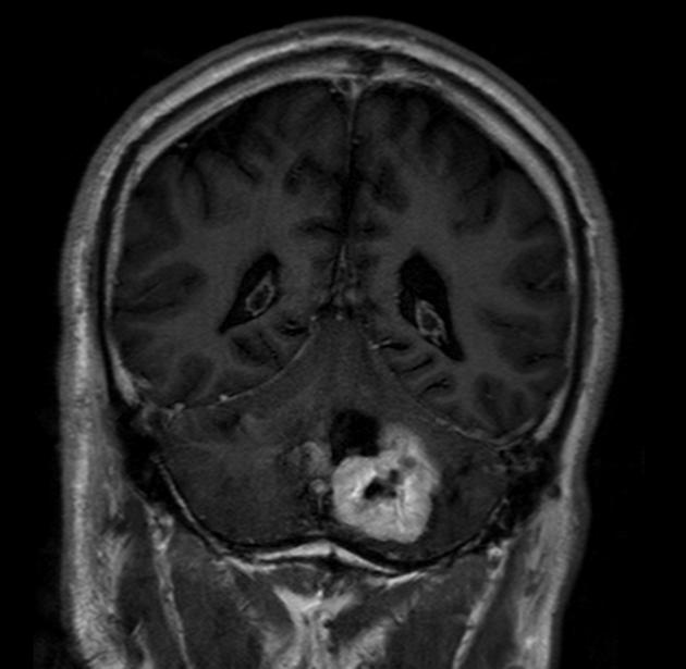 Brain_Hemangioblastoma_Radiology4.jpg