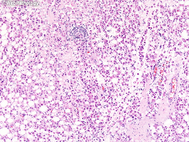 Breast_LobularCA44_Histiocytoid.jpg