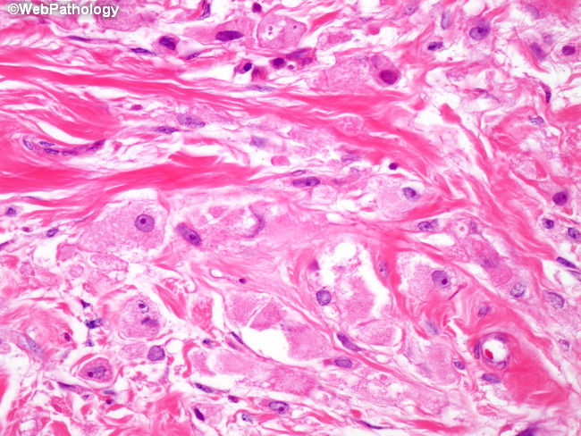 Breast_LobularCA55_Histiocytoid.jpg