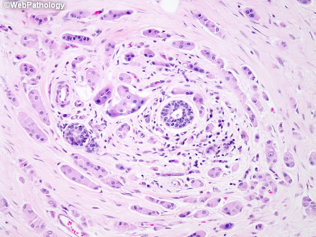 Breast_LobularCA56_Histiocytoid.jpg