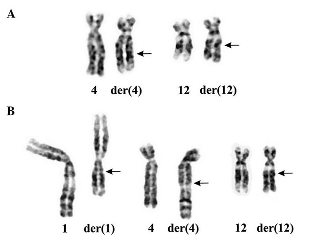 CG_Lipoma_Genetics3_Karyotype_resized.jpg