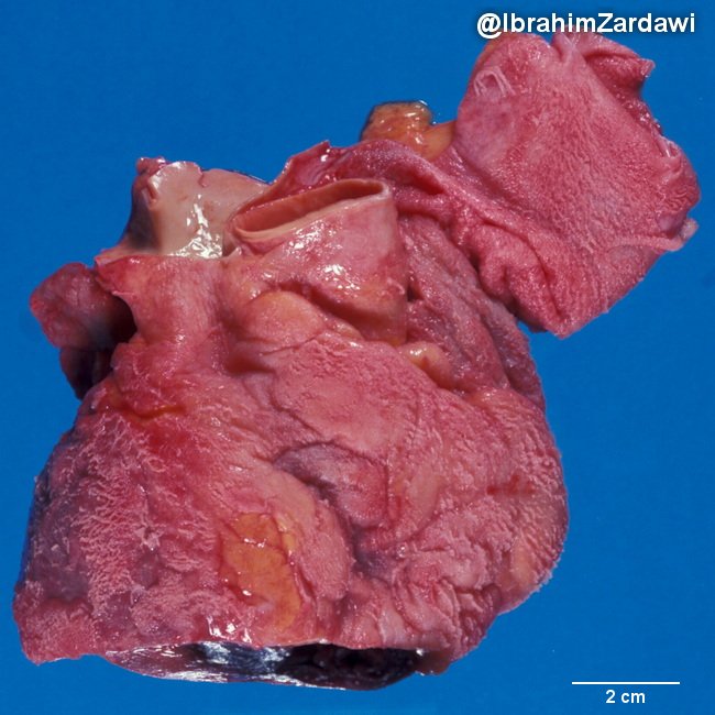 Cardiovascular_Pericarditis_Fibrinous7_Zardawi_ChRenalFailure.jpg