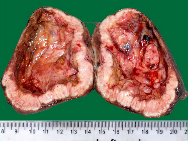 Endocrine_Thyroid_PapillaryCA1_Gross.jpg