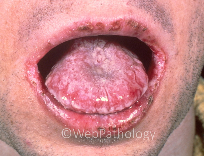InfectiousDx_Candida_OralCavity1(1).jpg