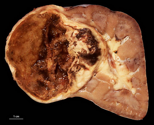 Kidney23_PapillaryRCC_Resized.jpg
