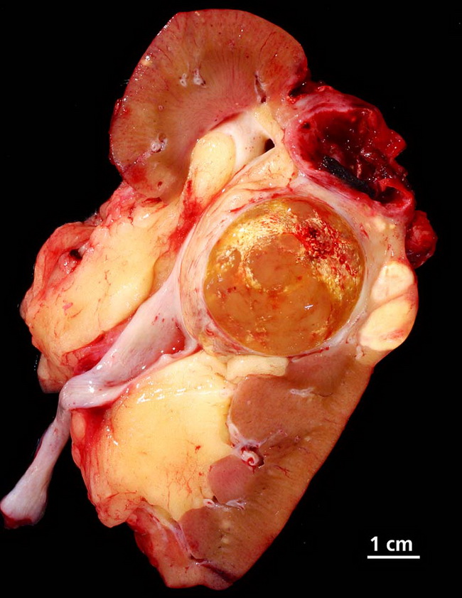 Kidney26_PapillaryRCC_resized.jpg