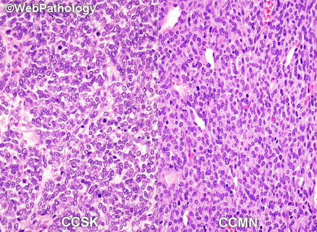 Kidney_CCSK_Composite2_resized.jpg