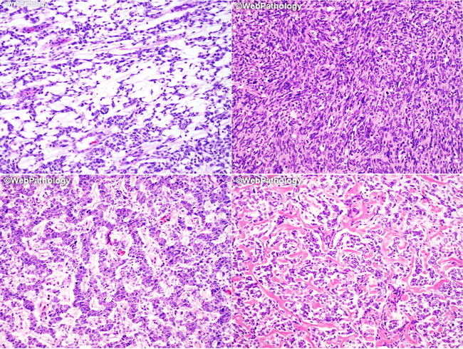 Kidney_CCSK_Patterns_Composite_resized.jpg