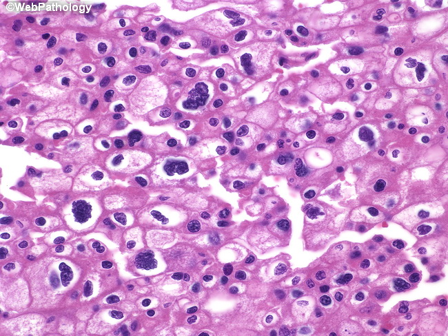 Kidney_ChromophobeRCC2.jpg