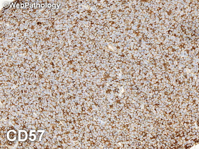 Kidney_MetanephricAdenoma40_CD57_resized(1).jpg