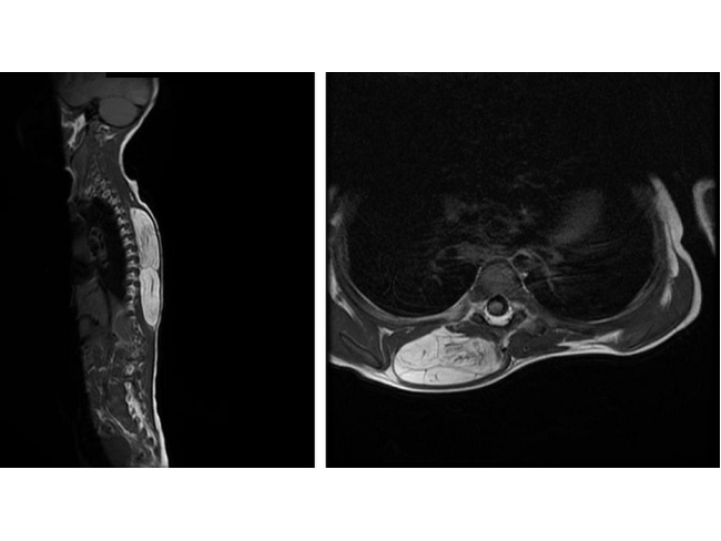 Lipoblastoma_Imaging2_Composite_resized.jpg