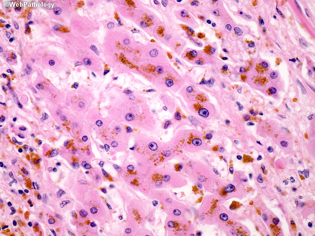 Liver_HCC16_Pseudoglandular_Hemochromatosis.jpg