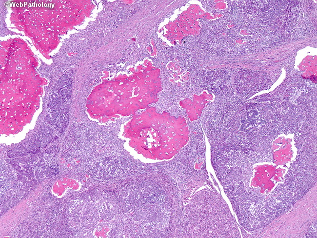 Liver_Hepatoblastoma10_Embryonal_Mesenchymal.jpg