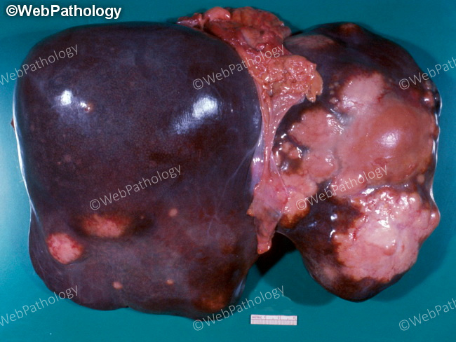 Liver_Metastases_SqCellCA_Lung2A.jpg