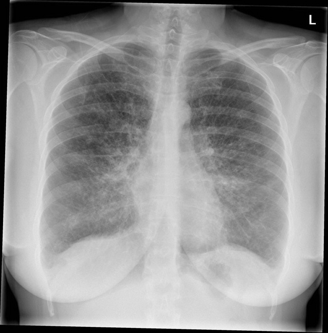 Lung_LAM_Radiology3.jpg