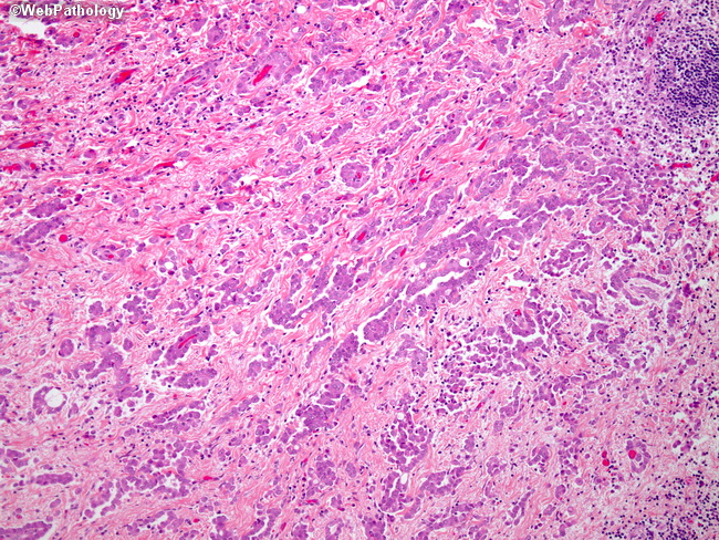 Lung_Mesothelioma3_TubuloPapillary.jpg