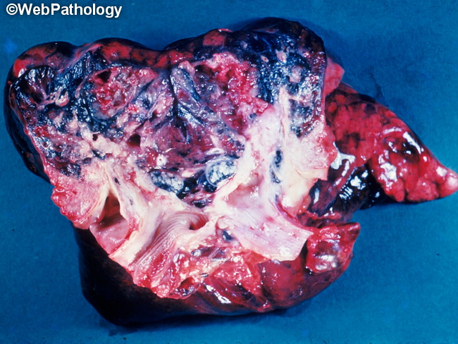 Lung_Neoplastic_SCC_Gross7_cropped.jpg