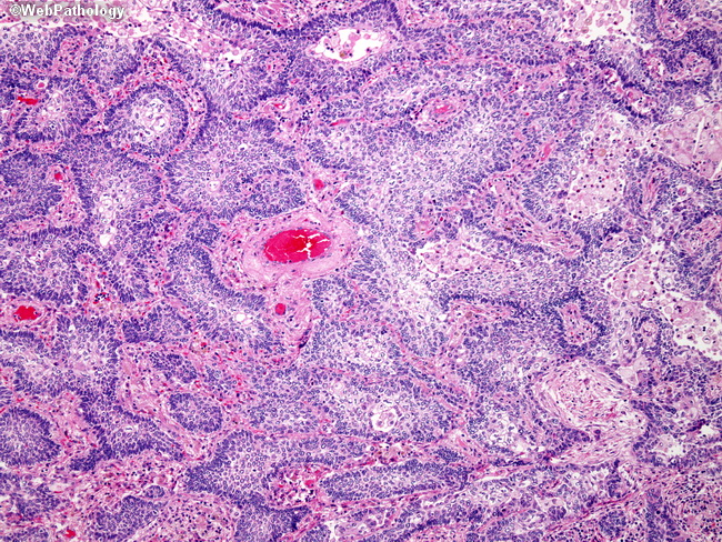 Lung_Neoplastic_SquamousCellCA19_Basaloid.jpg