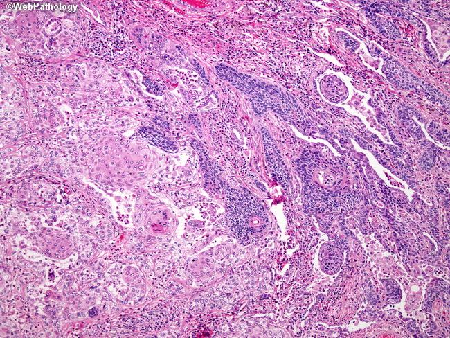 Lung_Neoplastic_SquamousCellCA21_Basaloid.jpg