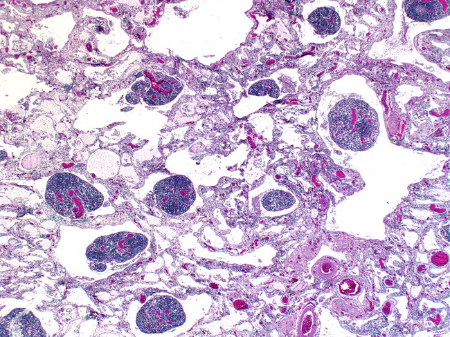 Retroperitoneal cystic lymphangioma in an adult: A case ...