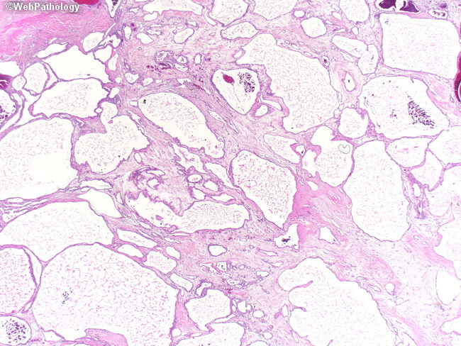 Pancreas_MicrocysticCystadenoma1(1).jpg