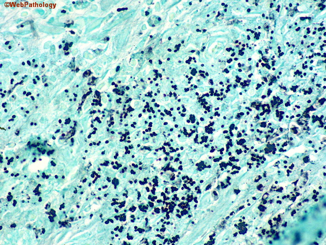 SmallBowel_Histoplasmosis3_GMS.jpg