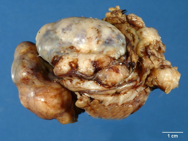 SoftTissue_DSRCT_Gross4_Peritoneal_resized.jpg