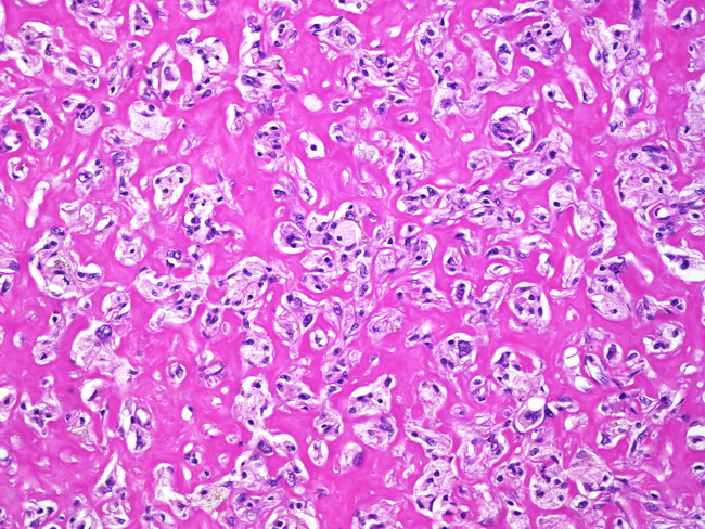 SoftTissue_Fibrohistiocytic_FibrousHistiocytoma_Lipidized_Leg.jpg