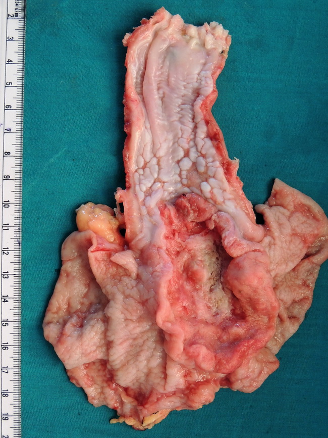 Stomach_AdenoCA_GEJunction2A_resized.jpg