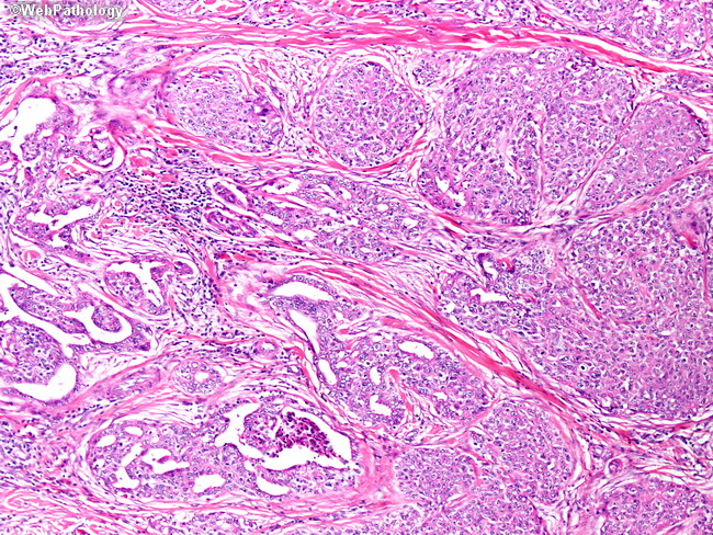 Eccrine carcinoma : a rare cutaneous neoplasm