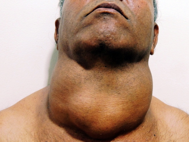 Thyroid_Goiter_Multinodular_Clinical2_cropped.jpg